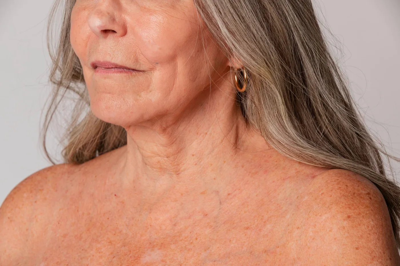 Saggy skin: Why Age Matters In Tweakment Planning