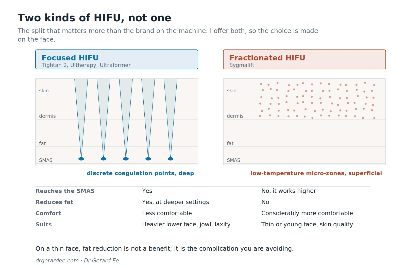 Diagram comparing focused HIFU and fractionated HIFU by energy delivery, depth, comfort and who each suits