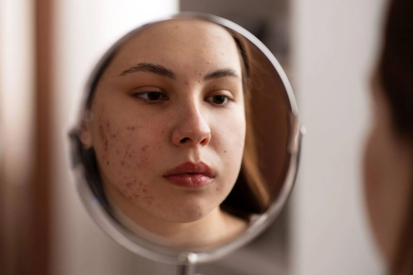 Ice pick, boxcar and rolling acne scars compared