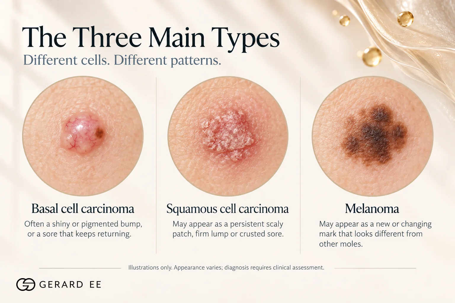 The three main types of skin cancer compared, basal cell carcinoma, squamous cell carcinoma and melanoma