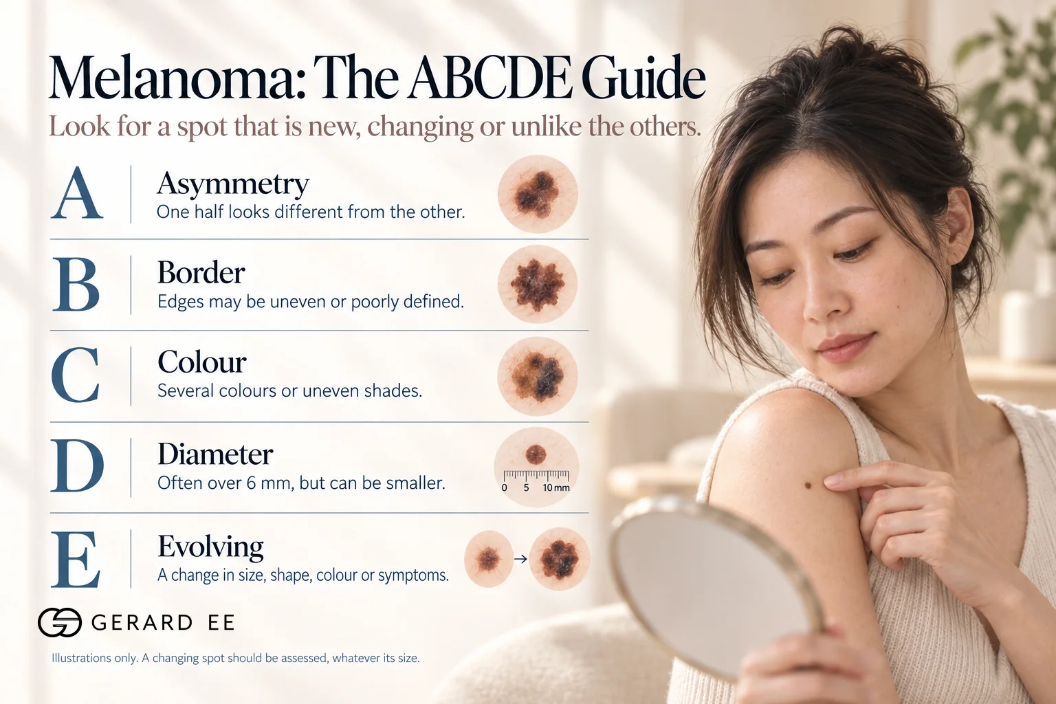 Melanoma warning signs, the ABCDE guide to asymmetry, border, colour, diameter and evolving