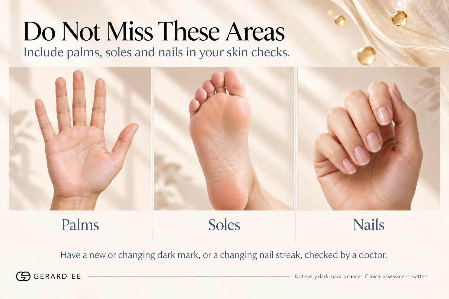 Types of skin cancer in Asian skin, check palms, soles and nails for a new or changing dark mark or nail streak