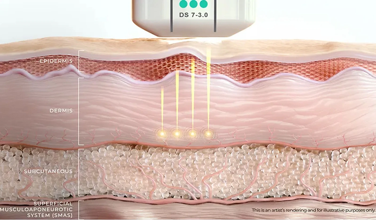 Ultherapy Prime diagram Diagram of Ultherapy Prime treatment depths