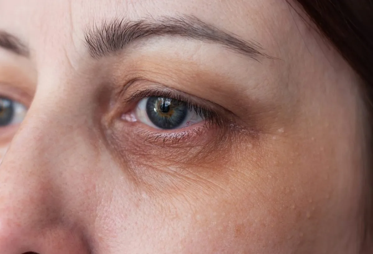 Under-eye skin boosters compared for dark circles and fine lines