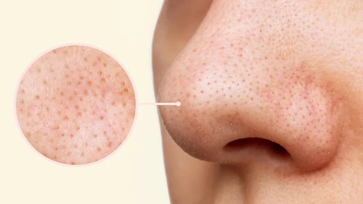 Black heads removal: Understanding Blackheads & Whiteheads