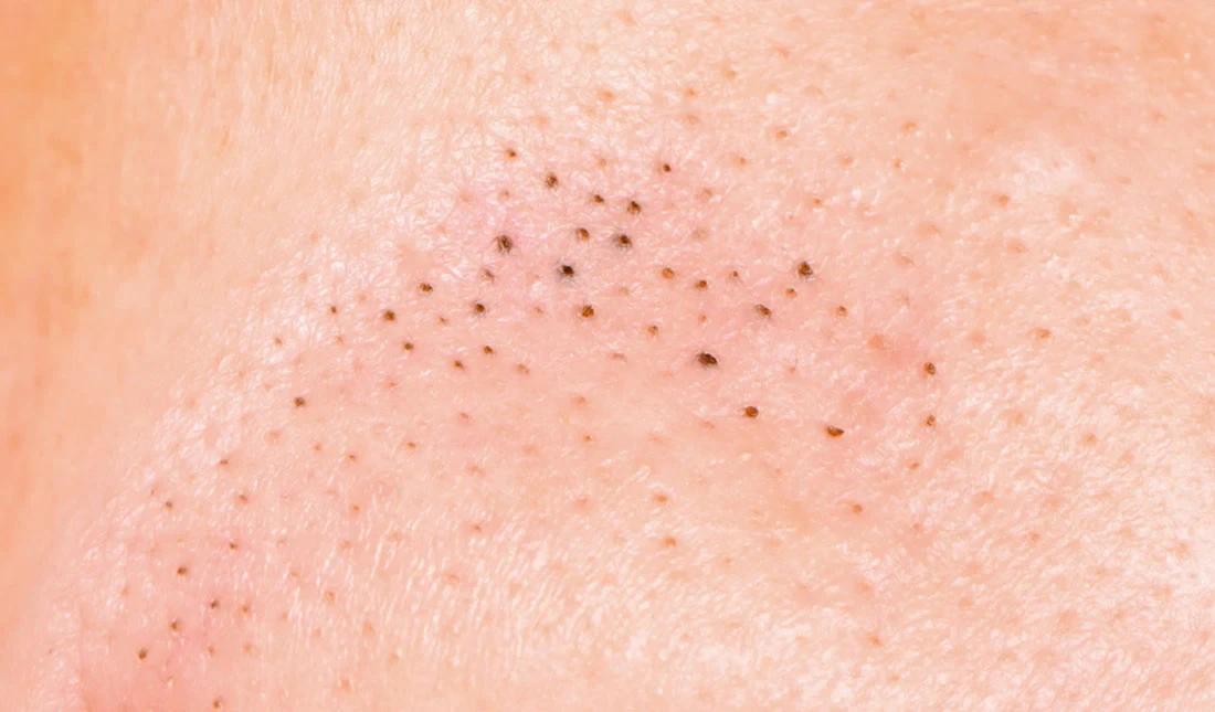 Blackheads and whiteheads, open and closed comedones