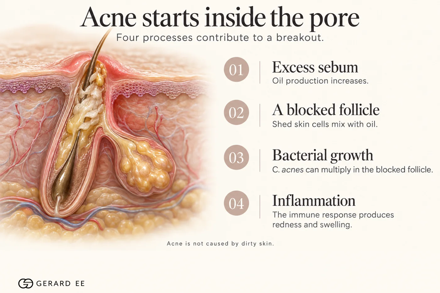 What causes acne inside the pore: excess sebum, a blocked follicle, C. acnes growth and inflammation