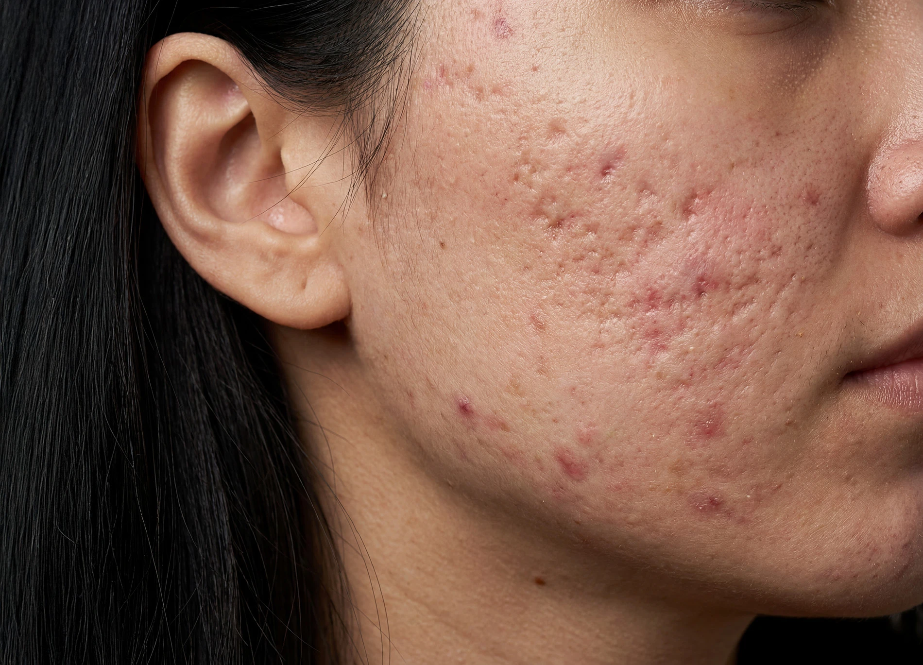 Depressed atrophic acne scars
