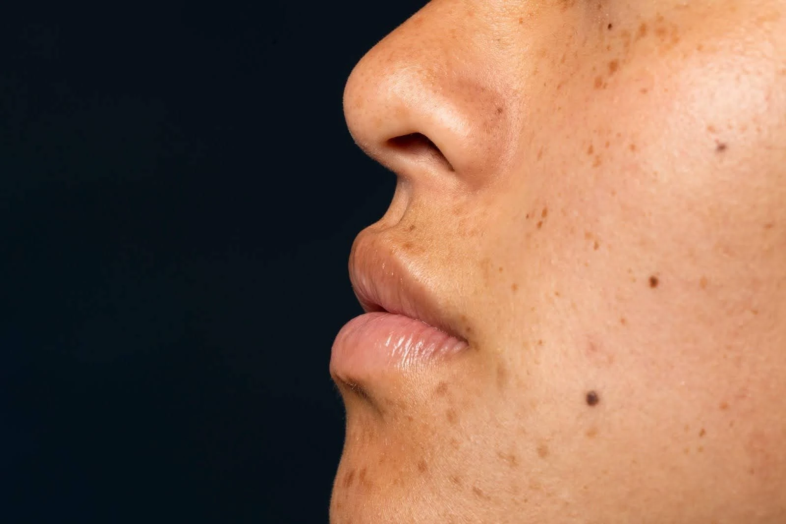 Pigmentation on facial skin