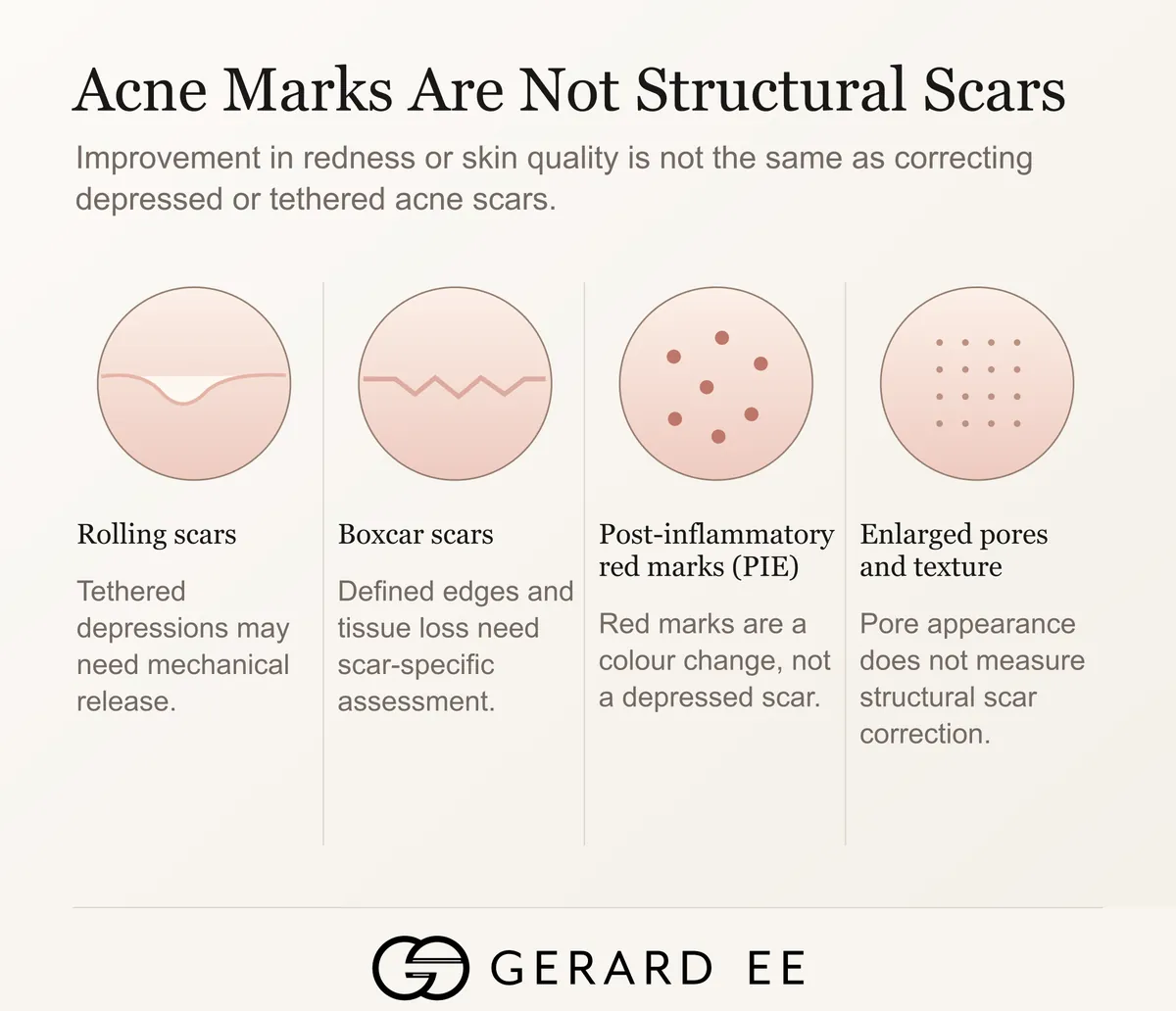 Acne marks are not structural scars, rolling and boxcar scars versus red marks and pores for Sylfirm X