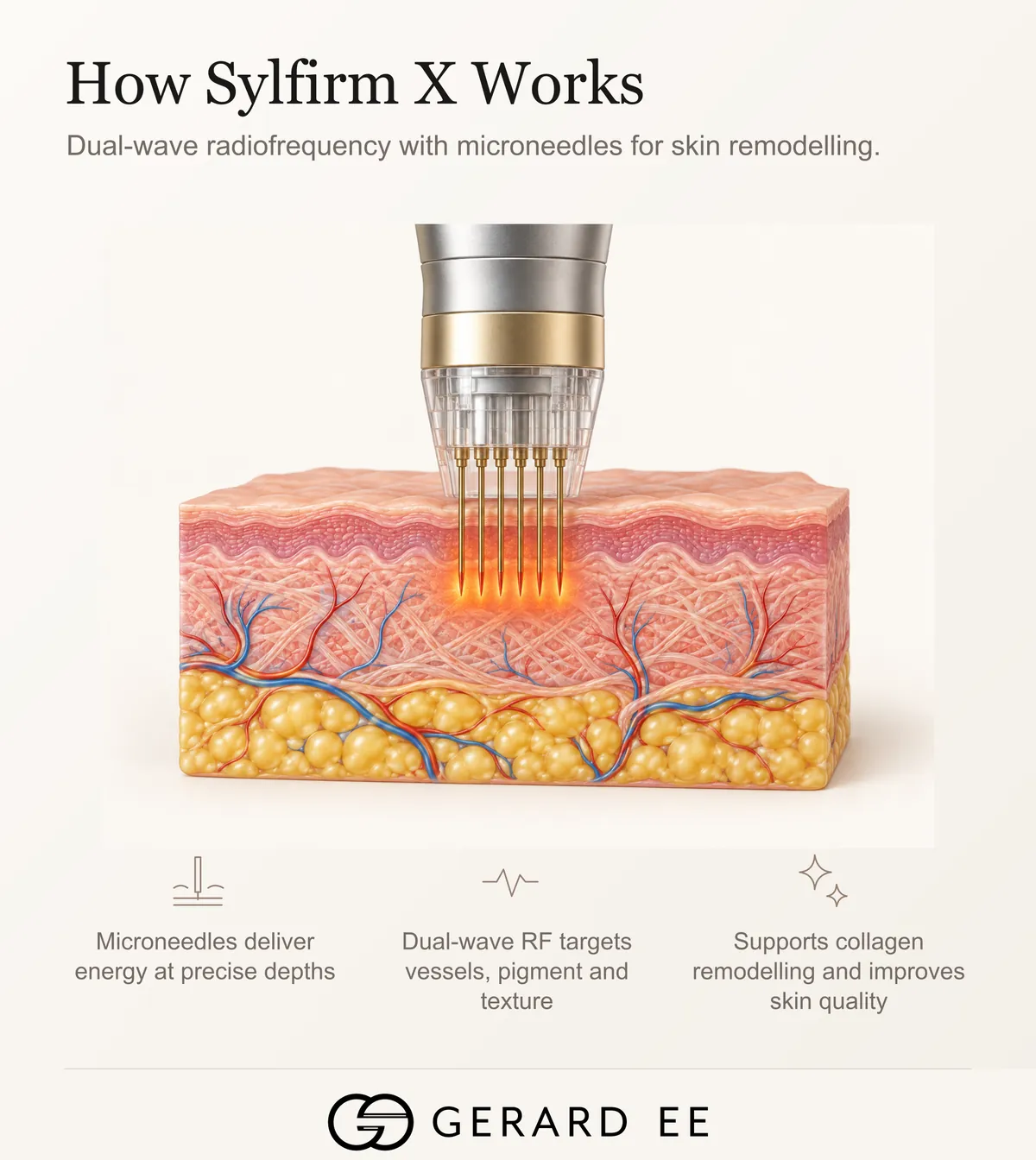 How Sylfirm X works, dual-wave RF microneedling for vessels, pigment and skin quality