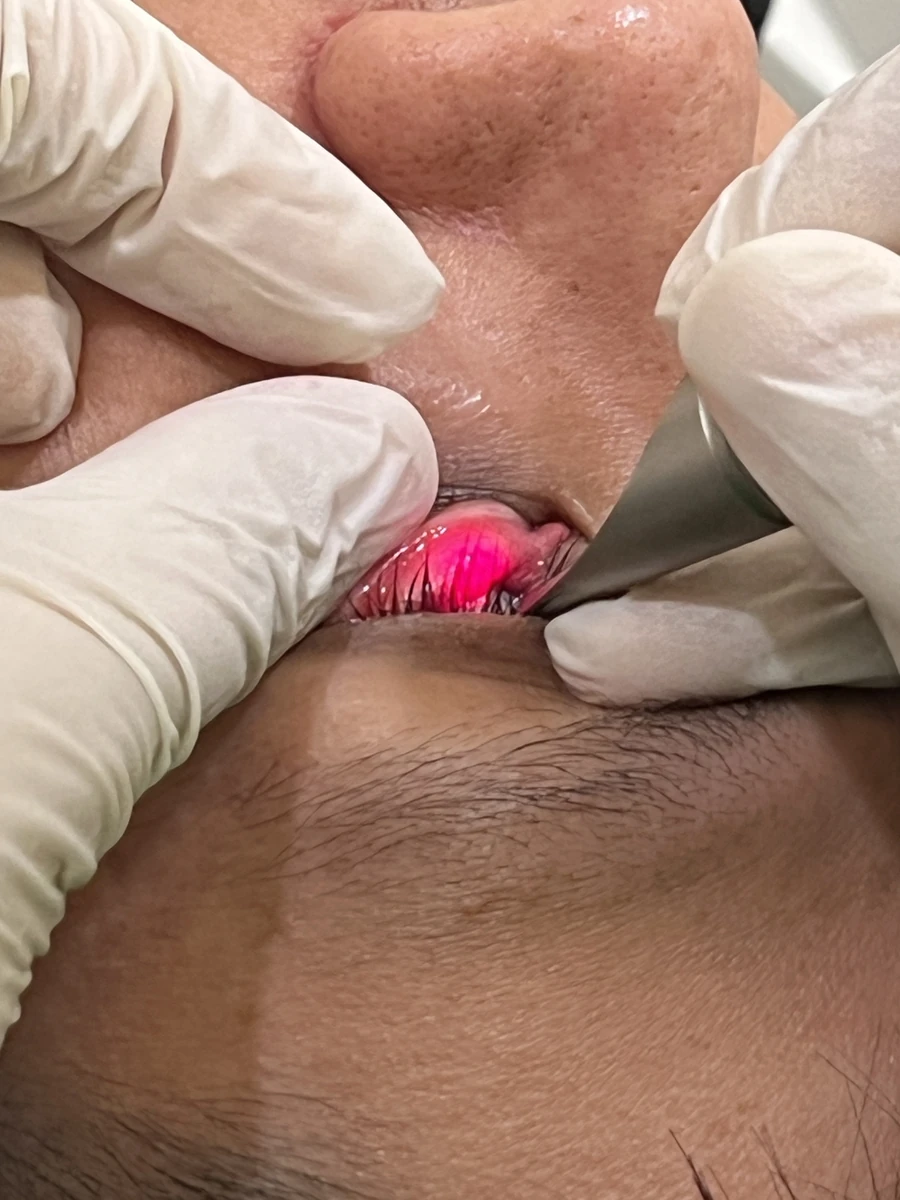 4D eye bag removal, Er:YAG aiming beam on the conjunctiva, two tissue layers away from the fat pad