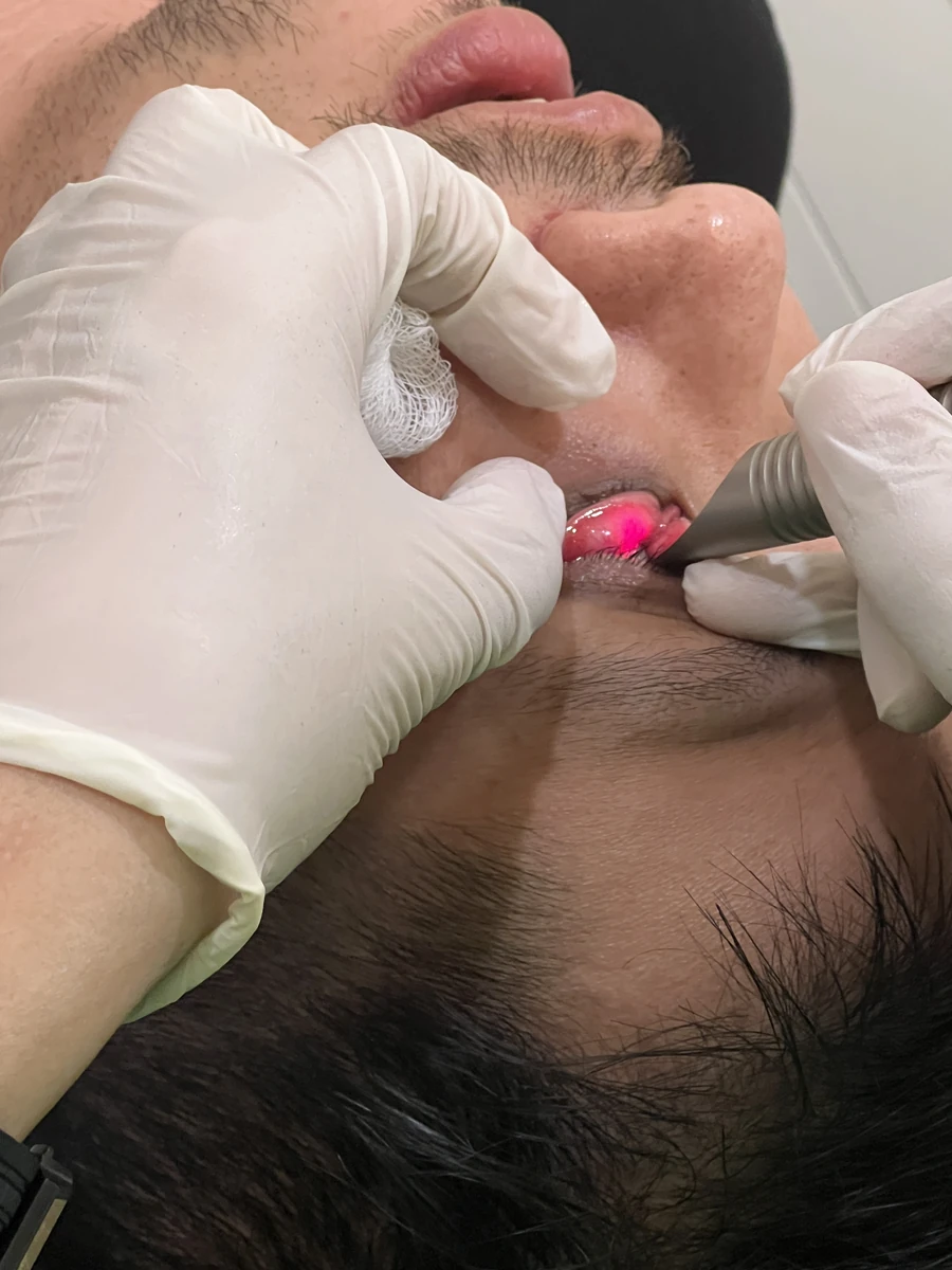 4D eye bag removal, lower eyelid everted with gauze to expose the conjunctiva