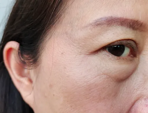 How to Prevent Eye Bags, and Why Some Cannot Be Prevented