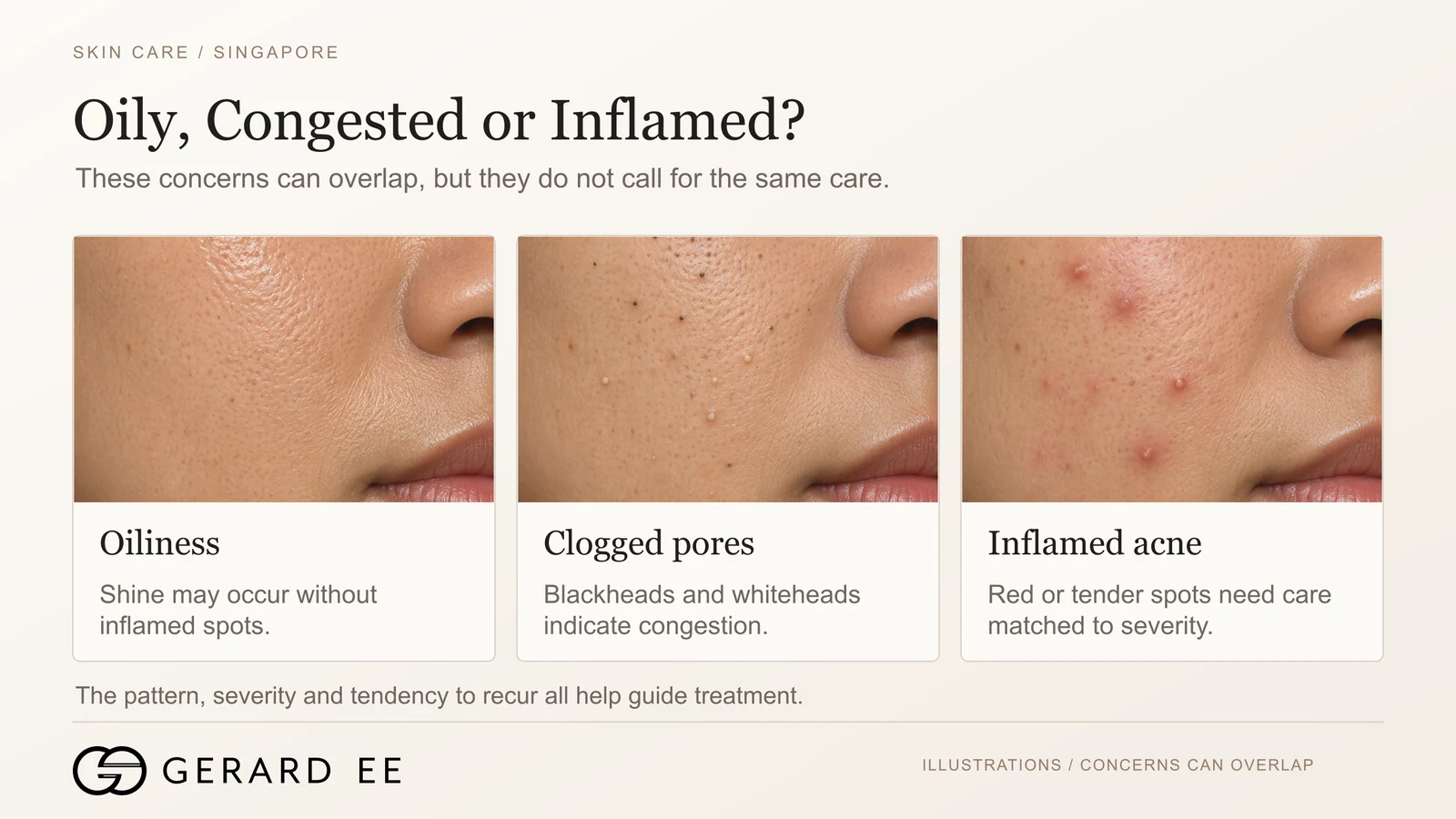 Oily skin vs clogged pores vs inflamed acne, three different concerns on oily skin