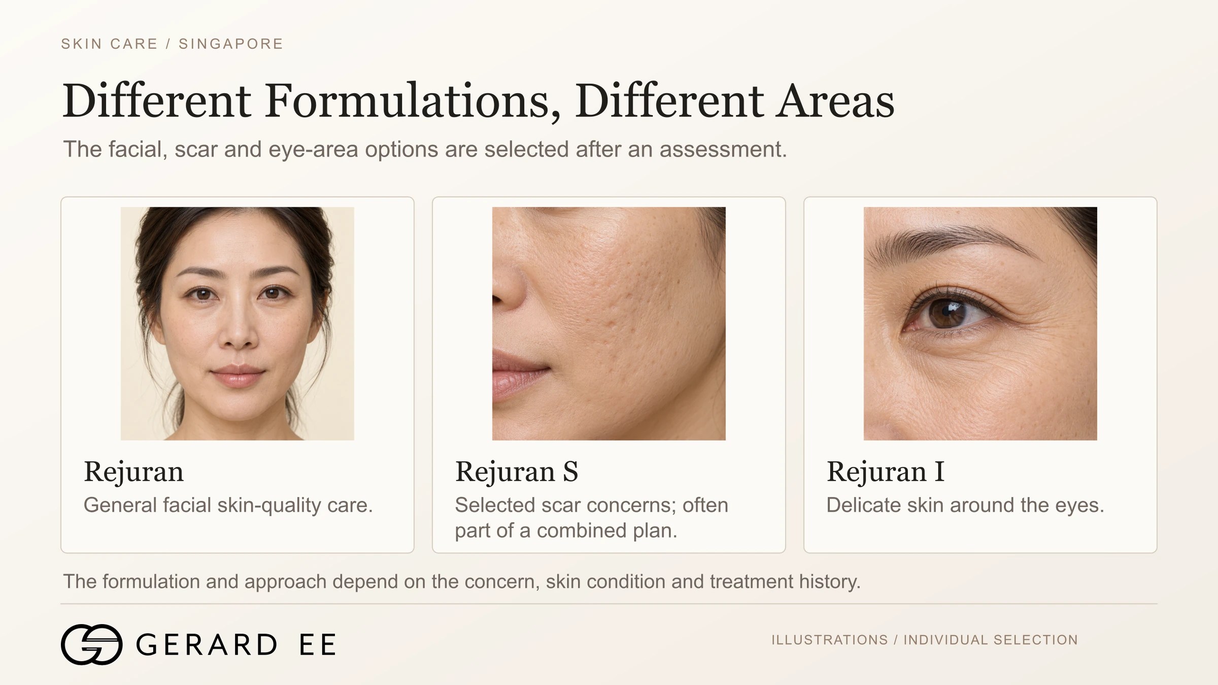 Rejuran, Rejuran S for acne scars and Rejuran I for the eye area, different formulations for different areas